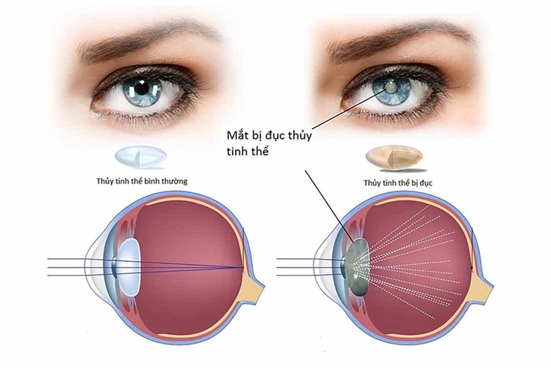 Đục thủy tinh thể có nguy hiểm ? Có cần thiết phải mổ không?